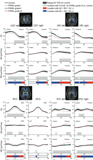 FIG 3. Changes in DTI metrics (FA, AD, and RD) along white matter tracts in preterm neonateswith PWML grades I, II, and III compared with controls.