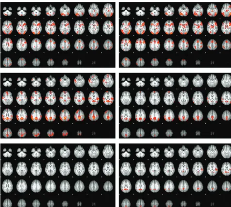 FIG 1. The activation (subjects with SCD (top row) and the default mode (middle row) responses to the word stem paradigm in the controls (left column) andright column)