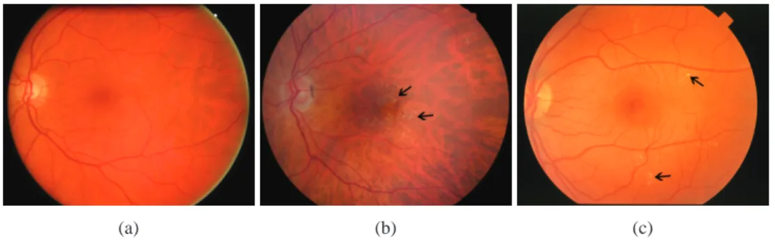 Fig. 1. Examples of color fundus images. (a): Control case, (b): image showing the presence of drusen and (c): image showing the presence of exudates.