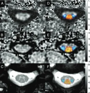 FIG 1. Representative images showing FA maps (A), MTR maps (B), and T2*WI (C) with probabilisticmaps of the lateral corticospinal tracts (blue) and dorsal columns (red-yellow) overlaid (D–F)following registration to the SCT atlas.