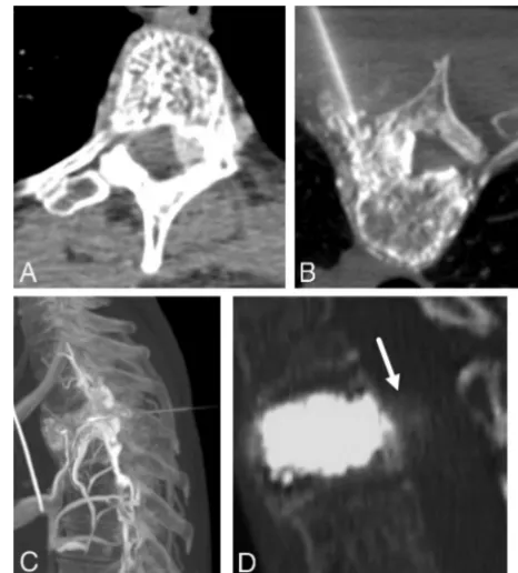 FIG 5. A 46-year-old man with upper back pain due to an aggressiveT3 hemangioma. A, Axial contrast-enhanced CT scan demonstrates anaggressive T3 hemangioma with intraosseous and extraosseous com-ponents