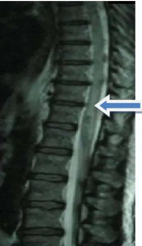 Figure 1. From T9 to T12. Intra medular hyperintensity on EST2 and FLAIR sequences. 