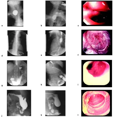 Figure 1. AP — anterior-posterior (radiological view of oesophageal diverticula and its endoscopic picture (its endoscopic picture (ticula (a), lateral (b) radiological view of Zenker’s diverticula and its endoscopic picture (c); AP (d), lateral (e)f); AP 
