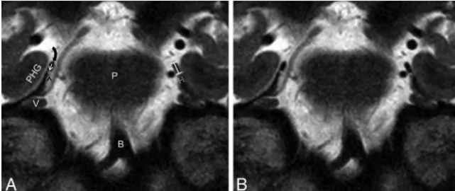 FIG 3. Labeled (A) and unlabeled (B) coronal T2 DRIVE images demonstrate cranial nerve IV (blackarrowhead on the patient’s right) in cross-section traveling along the bilateral trochlear grooves(straight white arrow on the patient’s right)