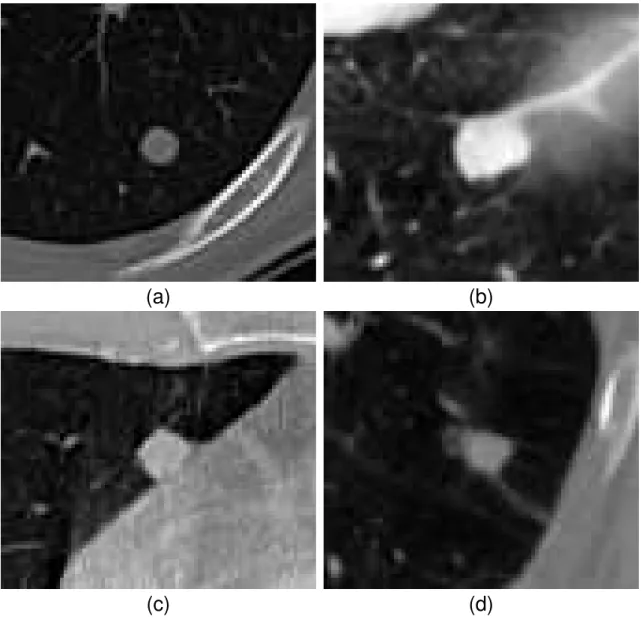 Figure 2. Classification of lung nodules based on attachment. (a): Well- Well-circumscribed, (b): Juxta-vascular, (c): Juxta-pleural, (d): Pleural tail