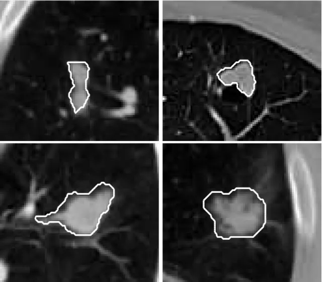 Figure 3. Nodules appear with different shapes in the lung