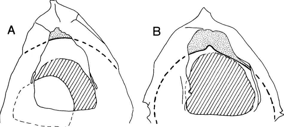 Fig. 3. Archaeopyle and opercular style in Tubotuberella ( x 1250). A. T. apatela. Specimen with operculum displaced, but retained within the cyst