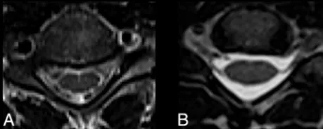 FIG 3. CSF visualization on T2-FSE and T2-SPACE. There is consider-able CSF pulsation artifact on axial T2-FSE (A) compared with no suchartifact on axial T2-SPACE (B).