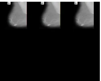 Figure 6(a). Acquired mammogram (mdb001) with noise and  artifacts 