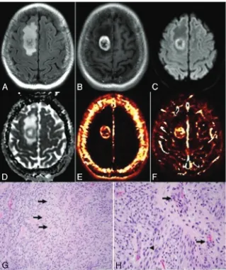 FIG 2. Glioblastoma. Axial FLAIR (A), contrast-enhanced T1-weighted (B), diffusion-weighted (C), ADC(D),permeabilitytransferconstant(E),andplasmavolume(F)imagesrevealaheterogeneouslyenhanc-ing tumor in the right frontal lobe with peripheral diffusion restr