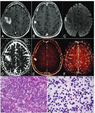 FIG 3. Primary CNS lymphoma. Axial FLAIR (cellular tumor without marked neovascularity, typical for primary CNS lymphoma