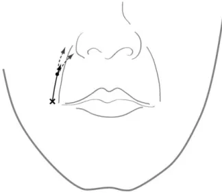 Fig. 2 Injection technique for nasolabial fold correction with calcium hydroxylapatite