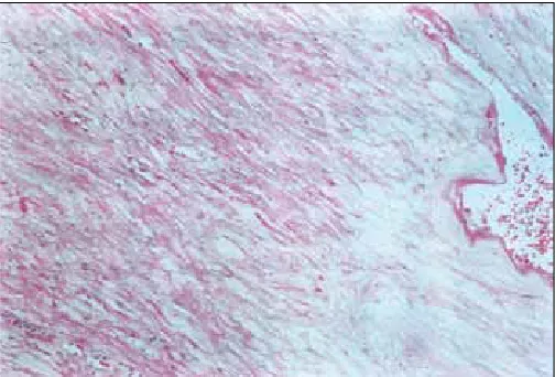 Fig. 4. Aspect histologique : groupement des fibres musculaires lisses et des fibres de collagène en faisceaux entrecroisés correspondant à un léiomyome.