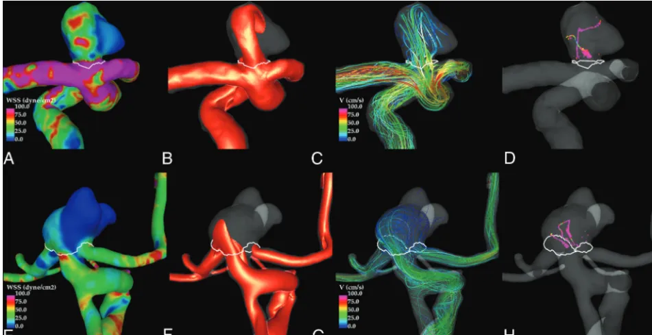 FIG 5. Examples of a ruptured (upper row) and an unruptured (lower row) ICAbif aneurysm