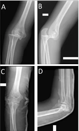 Fig. 1. A–B  –  plain elbow radiographs demonstrate a  posterolateral dislocation of the elbow