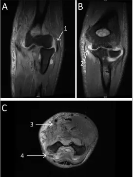 Fig. 3. A–C – MRI scans of the right elbow joint three weeks after trauma. 1  –  rupture of the lateral collateral ligament, 2 – rupture of the medial collateral ligament, 3 – median nerve oedema, 4 – ulnar nerve oedema