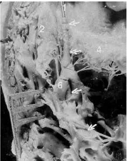 Figure 4. Polyurethane-insulated electrode with marked fibroustissue about the electrode tip (arrows)