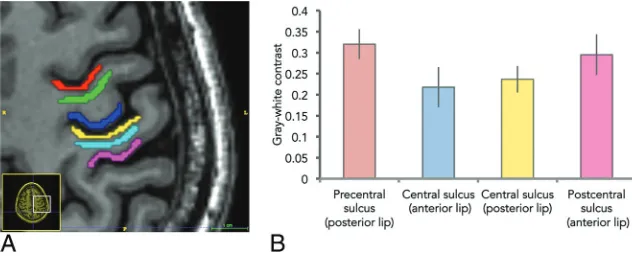 FIG 1. The “white gray sign.” Axial high-resolution 3D inversion recov-ery fast-spoiled gradient-echo T1-weighted image demonstrates de-creased gray-white contrast of the anterior and posterior corticesalong the central sulcus (white arrow).