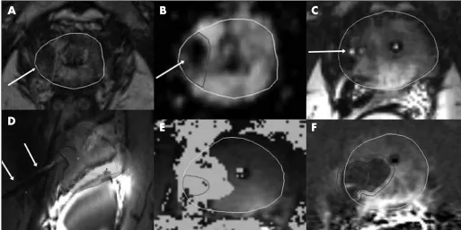 Fig. 1. MP-01.03. Focal laser ablation therapy of a Gleason 7 tumor in the right apex peripheral zone