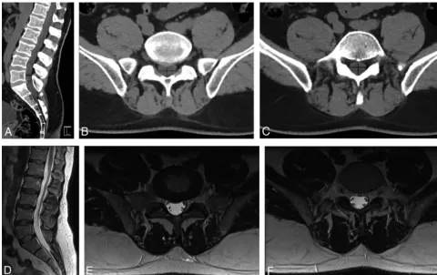 FIG 1. A 50-year-old man with acute-onset bilateral lower extremity numbness and severe low back pain