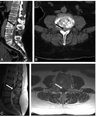 FIG 3. A 59-year-old man with metastatic renal cell carcinoma with worsening left lower extremity pain and difﬁculty ambulating