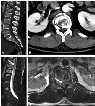 FIG 5. A 42-year-old woman with lumbar back pain following trauma. CT (into the spinal canal (readers determined that CT-PTSE may beA and B) demonstrates a burst fracture of L1 with retropulsion of bonesolid arrow)