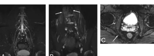 FIG 1. A 43-year-old woman with an intradural calciﬁed lesion and piriformis syndrome (patient 11, On-line Table)