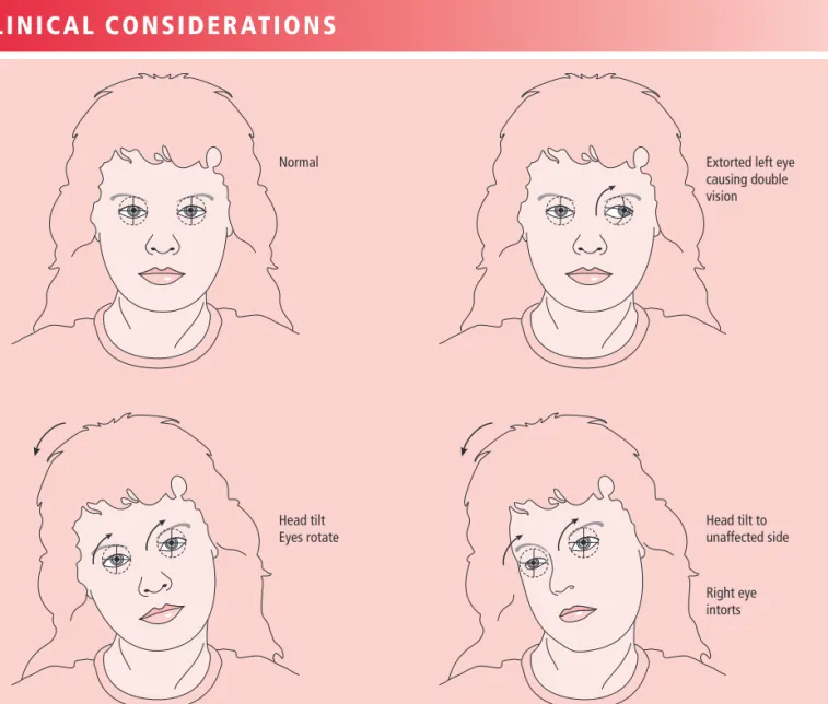 Figure 15.4 = (A) Normal: When the head is tilted, the eyes rotate in the opposite direction