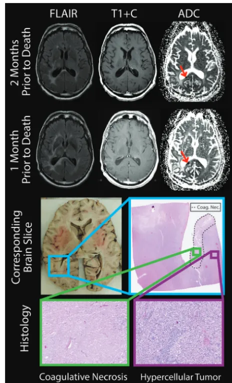 FIG 3. The brain section and corresponding imaging from a represen-tative patient. The diffusion-restricted lesion (red arrows) was grow-ing between the 2 imaging sessions, shown 2 months and 1 monthbefore death