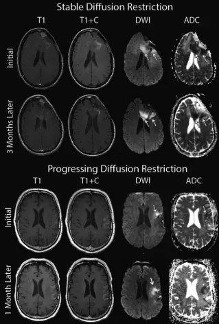 FIG 4. Examples of stable and progressive diffusion-restricted lesions occurring following theonset of bevacizumab treatment.
