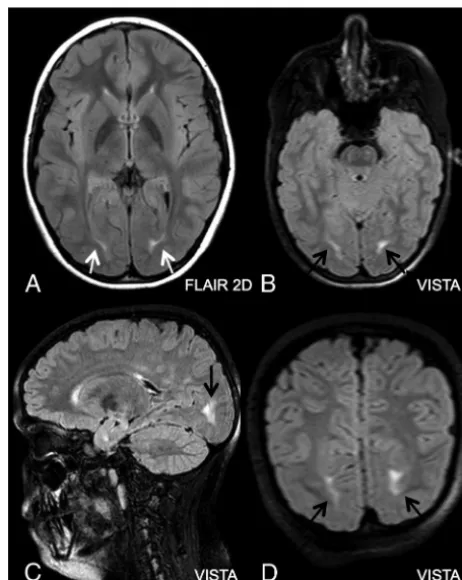 FIG 1. T2 hyperintensity of the WM adjacent to the occipital horns ofimaging for episodes of hypersomnia