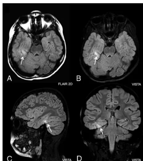 FIG 3. Abnormal focal T2 hyperintensity (arrows) consistent with fo-cal cortical dysplasia type II in the right fusiform gyrus of a 10-year-oldboy with partial epilepsy