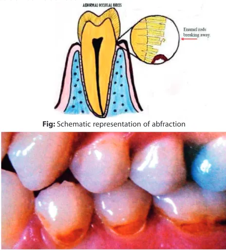 Fig: Schematic representation of abfraction