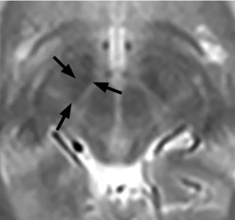 FIG 1. The smallest of the basal ganglia nuclei can be delineated onappropriate T2-weighted imaging through a region just cephalad tothe midbrain