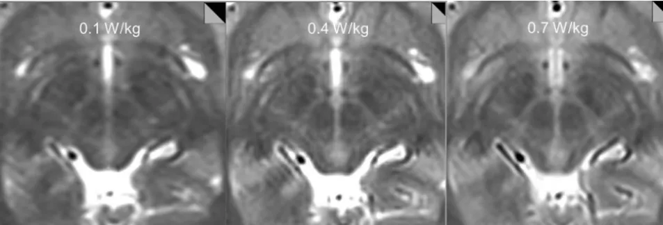 FIG 2. Tests on a volunteer subject show decreasing anatomic detail of the subthalamic region with decreasing SAR