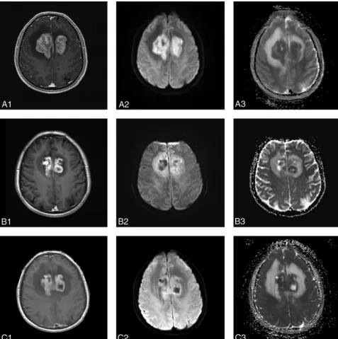 FIG 2. MR images in a 53-year-old man with diffuse large B-cell PCNSL belonging to the PR group (A1, A2, A3, before therapy; B1, B2, B3, after 1cycle of chemotherapy; C1, C2, C3, after 5 cycles of chemotherapy)