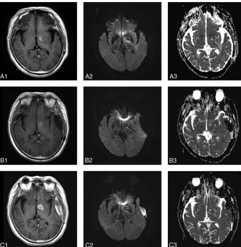 FIG 3. MR images in a 68-year-old man with diffuse large B-cell PCNSL, belonging to the PD group (A1, A2, A3, before therapy; B1, B2, B3, after 1cycle of chemotherapy; C1, C2, C3, after 5 cycles of chemotherapy)