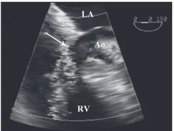 Fig. 4.  Case 2. TOE image of the shunt from the aorta to  the right ventricle (collor Doppler ﬂ ow – arrow)  through the interventricular septum (RV – right  ventricle, Ao – aorta, LA – left atrium)