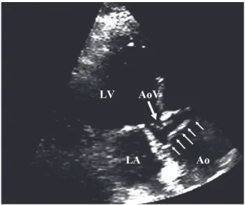 Fig. 5.  Case 3. Apical image shows a dissected intimal  ﬂ ap in the aortic root (multiple arrows)