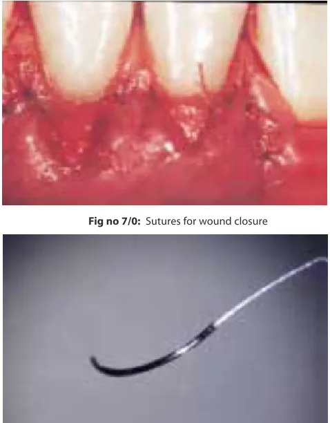 Fig no 7/0:  Sutures for wound closure