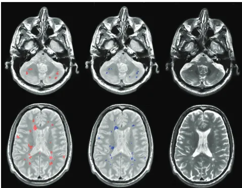FIG 3. Example lesion segmentations for 2 patients (rows) from 2 different scanners by the proposed method (operator segmentation (red) compared with the expertblue)