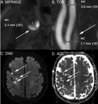 FIG 1. Carotid and brain MR imaging. Carotid IPH and maximum plaque thickness were detectedby using the MPRAGE sequence as shown in this representative image with right-sided carotid IPH(A)