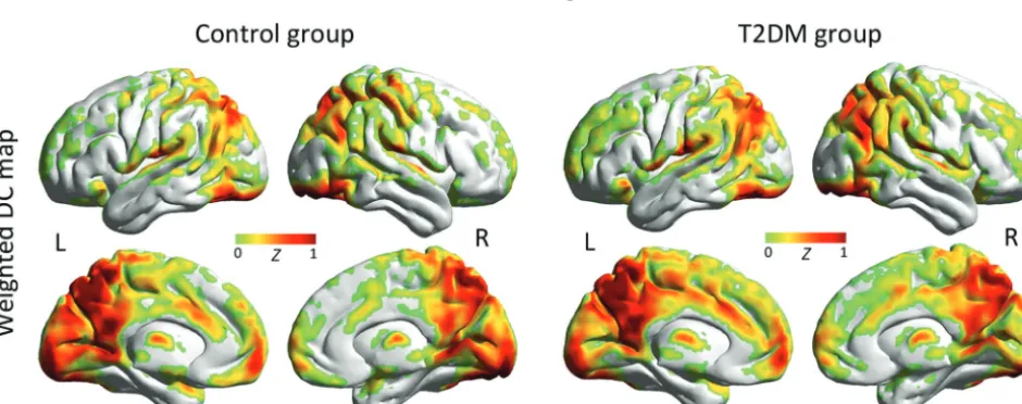 FIG 1. Spatial distribution of weighted DC maps in patients with T2DM and HCs (P � .05, family-wise error–corrected)