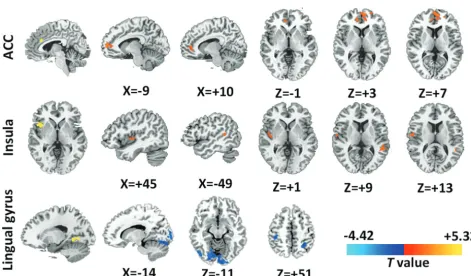FIG 4. Group differences of network connectivity based on the seed regions identiﬁed in the DC comparison (P � .05, AlphaSim-corrected).Regions with signiﬁcant connectivity differences in networks anchored in hubs with altered DC (ie, dACC, anterior insula