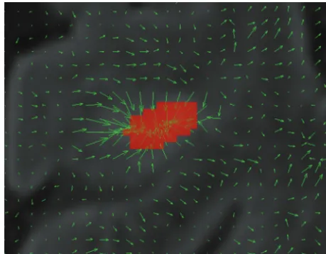 FIG 1. Example of the deformation ﬁeld inside a new lesion. All ar-rows point to the lesion center.