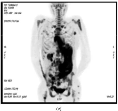 Figure 1. (a) echocardiogram demonstrating a right ventri- cular Inflow track showing the right atrial mass which extends to the tricuspid valve