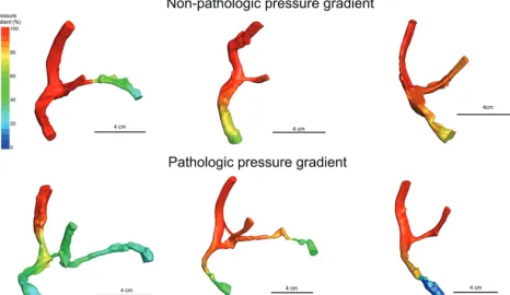FIG 1. Computational ﬂuid dynamics calculations of blood pressure gradients in the dural venous sinuses of patients with IIH