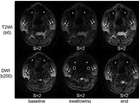 FIG 3. Magnetic susceptibility artifacts on T2WI and DWI. Mild dis-occur on all T2WI and DWI scans