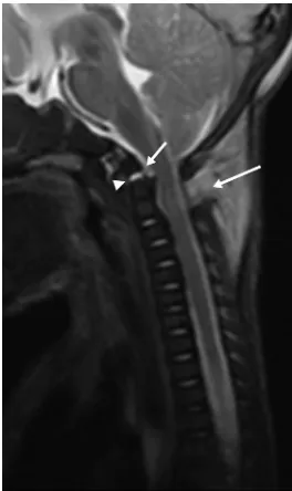 FIG 1. Three-month-old patient.marrow edema involving the lower cervical and upper thoracic vertebral bodies, most prom-inent at T1 (abnormal low attenuation in the basal ganglia