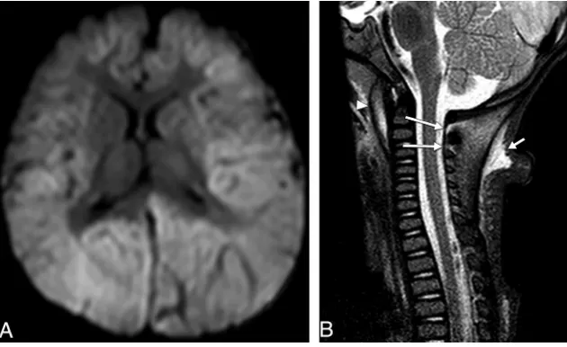 FIG 7. Seven-month-old patient.on the left. There is mild midline shift, left to right, caused by a left hemispheric convexitysubdural hemorrhage (not shown)
